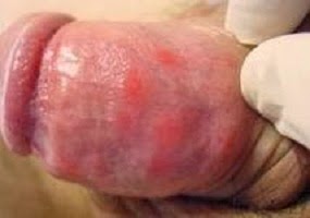 Penyakit Sipilis Pada Pria Penyakit Sipilis Pada Pria