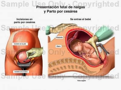 Resultado de imagen para nacimiento por cesarea