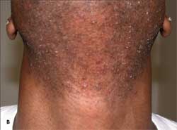 Scalp Folliculitis Cur...