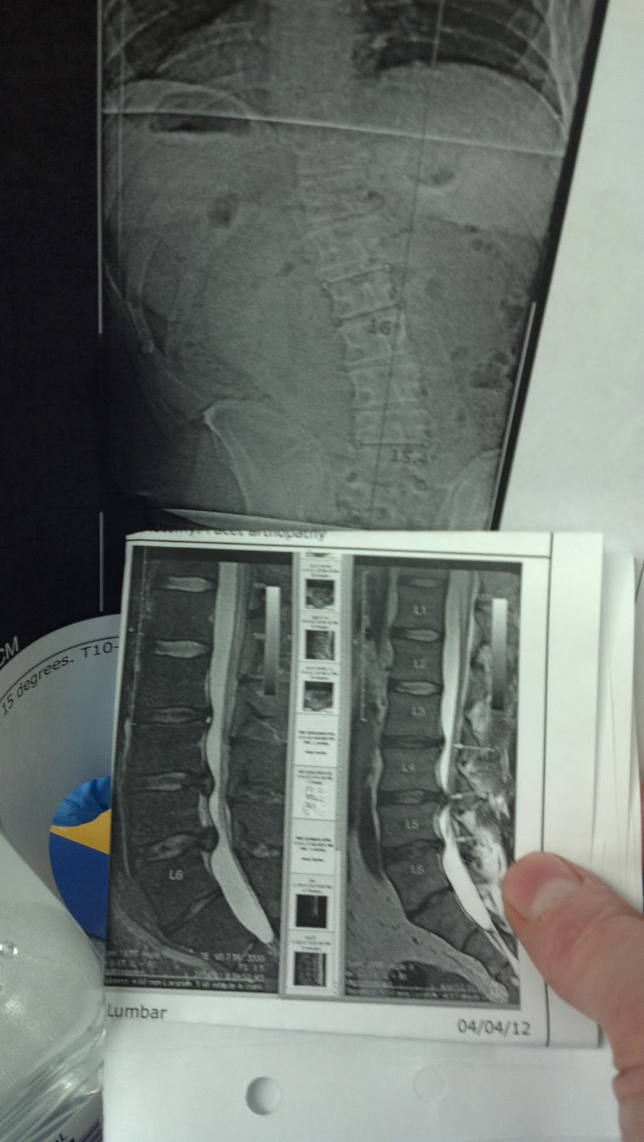 38 yo executive with huge trunk shift scoliosis caused by huge disc
