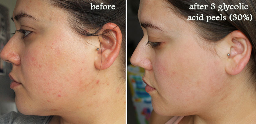 glycolic acid peels glasgow skin clinic before and after