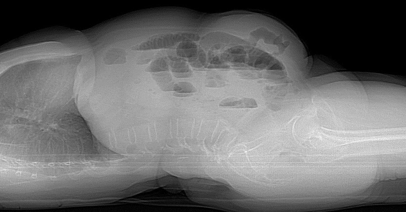 Radshare: ANTERIOR ABDOMINAL WALL INCISIONAL HERNIA