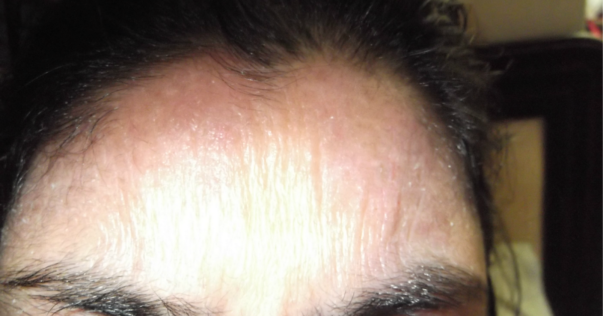 Eczema... The Constant Battle 3rd Day Post Injection