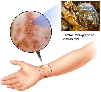 ما هو السل المقاوم للأدوية