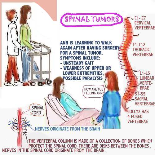 Tumor Spinal Cord Tumor Symptoms