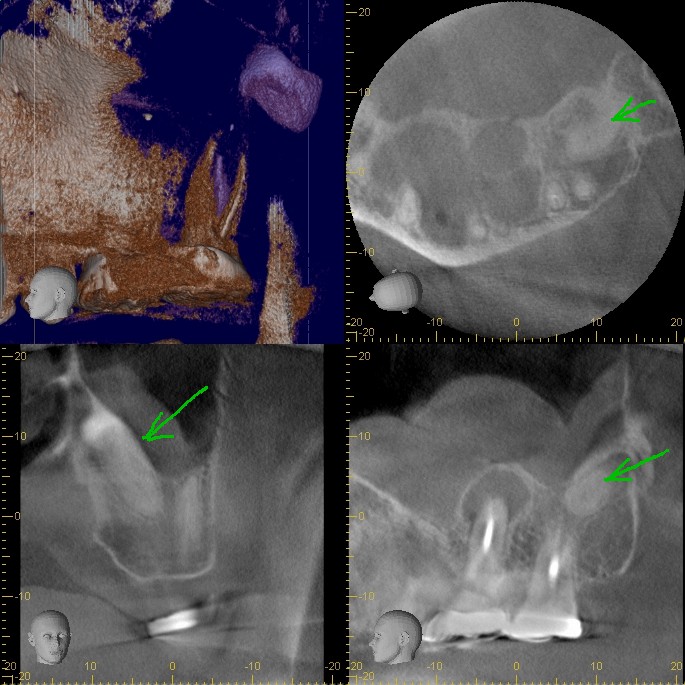 The Endo Blog Cone Beam CT in Endodontic Diagnosis
