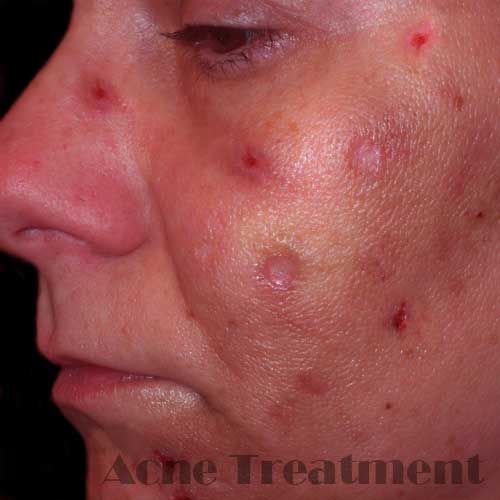 treatment for acne