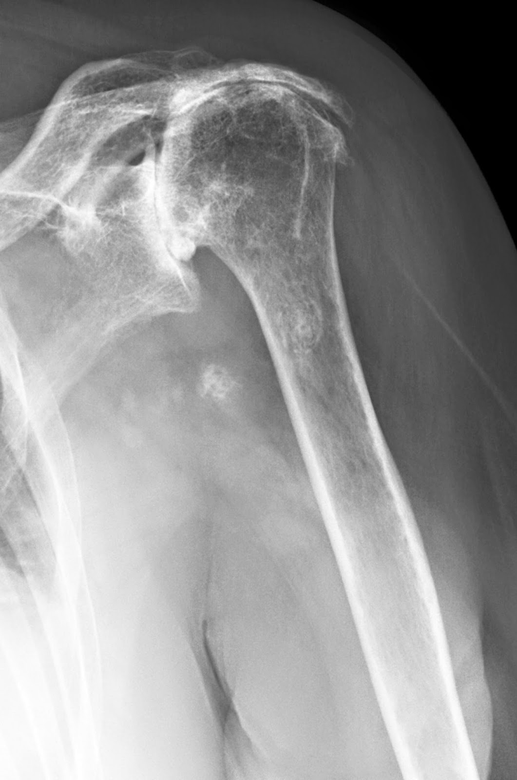 Shoulder Arthritis / Rotator Cuff Tears causes of shoulder pain