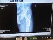 Hip xray at 5 weeks