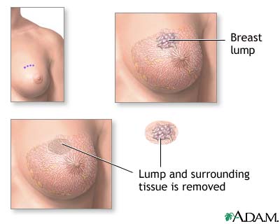 Lumps In Breast