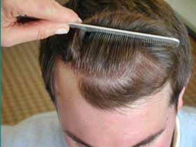 African Hairstyle 2015 Understanding Frontal Hair Loss