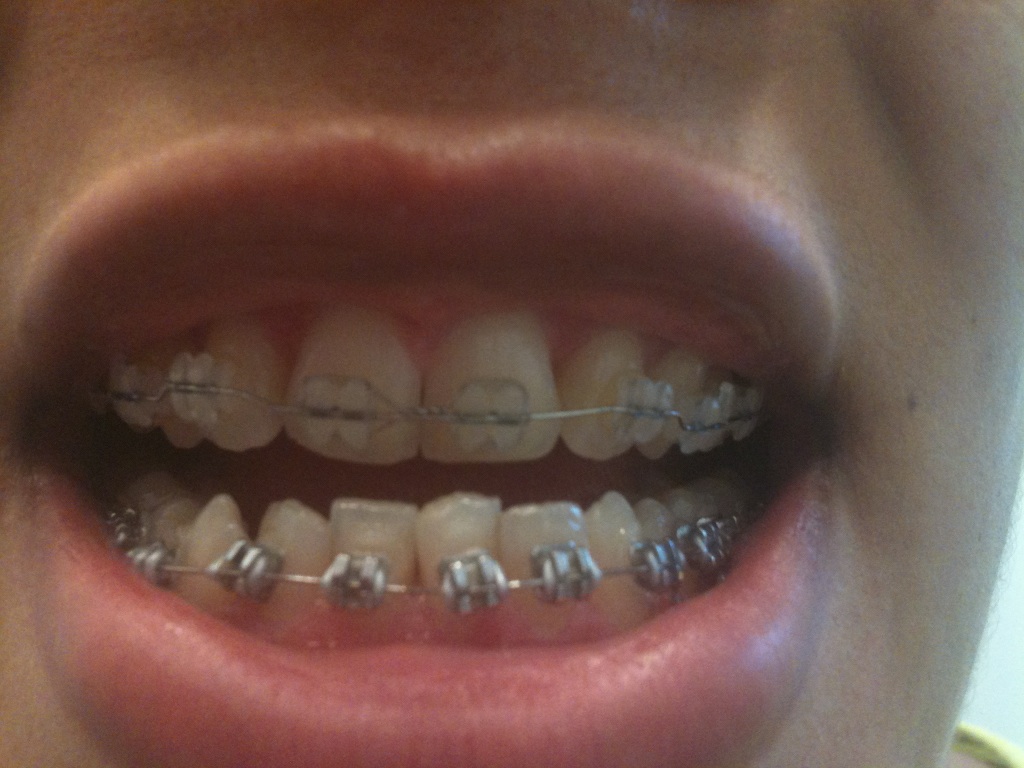 Braces Update and coils picts after trim