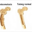 Pengobatan Tradisional Untuk Osteomalasia Ampuh | Pengobatan Tradisional Osteoporosis