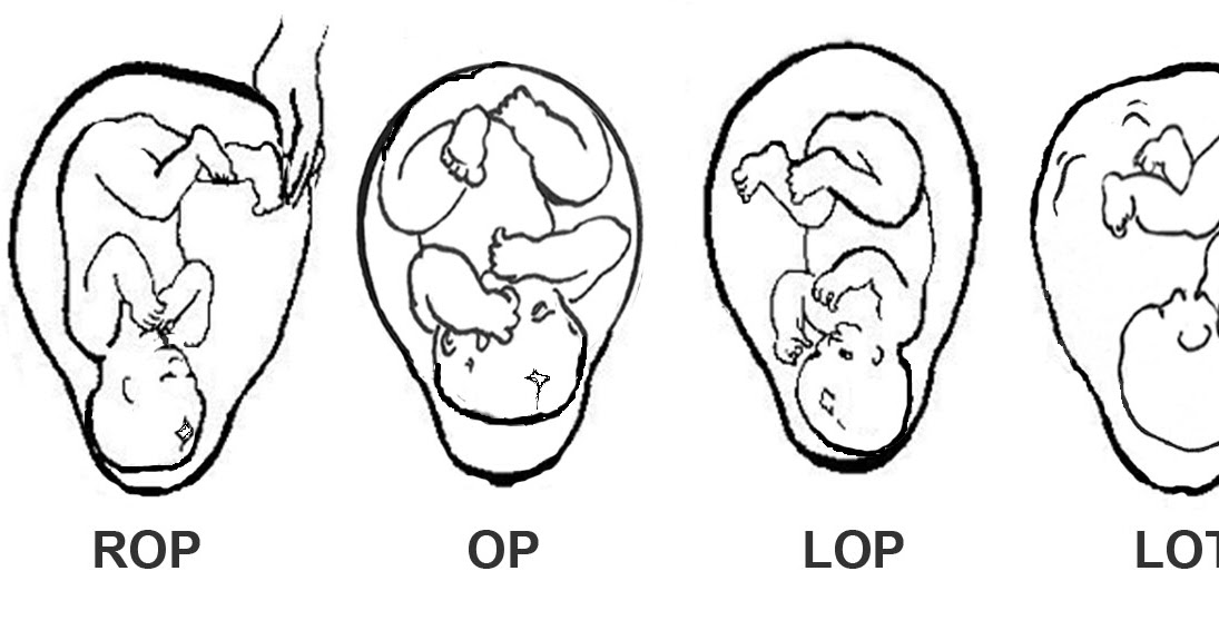 Spinning Babies Blog Where OP babies get stuck in labor and what to do