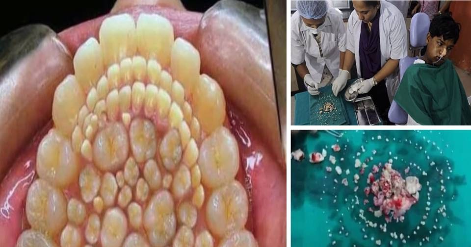 HOME DECOR This Boy has 231 teeth inside his mouth