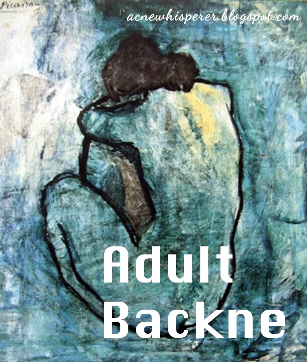 The Acne Whisperer 7 Ways to Clear Adult Backne