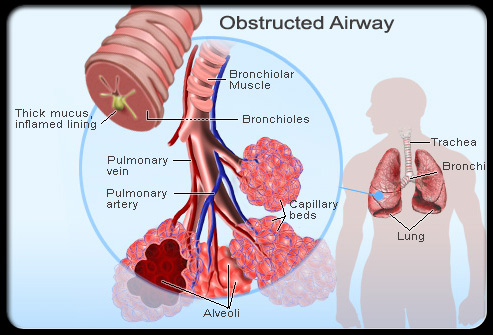 asthma stages