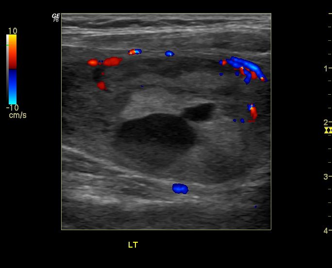 cochinblogs Colloid nodule of the thyroid 3D and elastography study