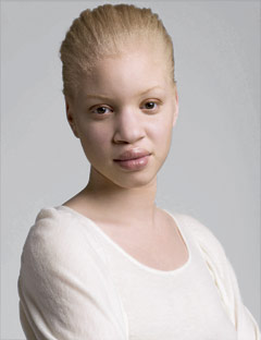Albinism Humans