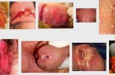 siplis obat sipilis manjur