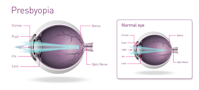 Lasik surgery for presbyopia
