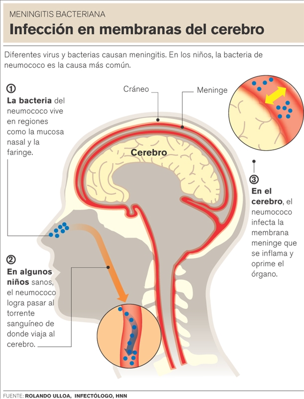 INFECTOCONTAGIOSAS EN CHILE: MENINGITIS MENINGOCÓCICA