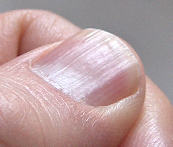 Diseases Of Nails