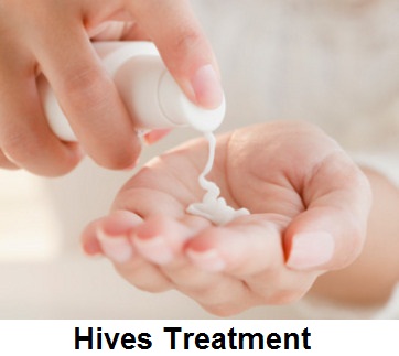 What are the symptoms of hives?