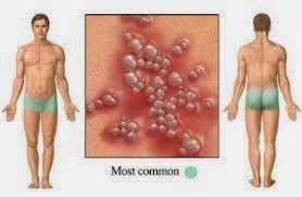 Foto Apa Itu Penyakit Herpes Genital