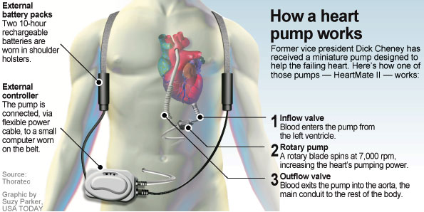 What are the benefits of an LVAD heart pump surgery?