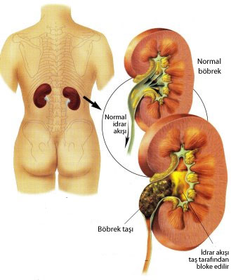 What are possible causes of kidney cysts?
