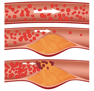 cholesterol in blood vessels