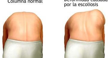 El régimen ortopédico a la escoliosis