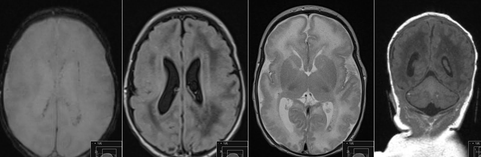 Cavum Velum Interpositum Mri