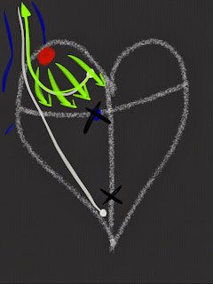 Complete Heart Block and Pacemakers Complete Heart Block and Pacemakers