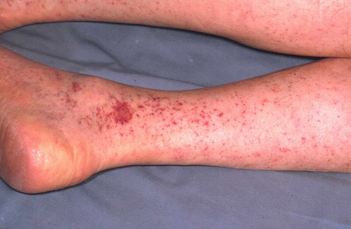 ECC EDUCATION Case Presentation October 2013 "Bounce Back Rash"