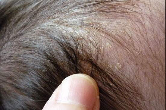 Causes of Dry Scalp in Infants and Children