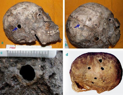 Harappa_Brain_Surgery.jpg