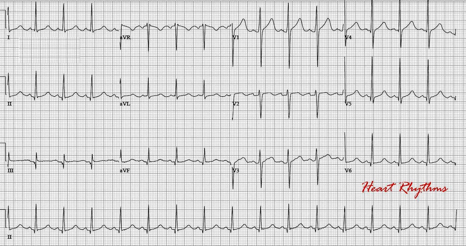 ECG Rhythms Prolonged QTc due to hypocalcemia