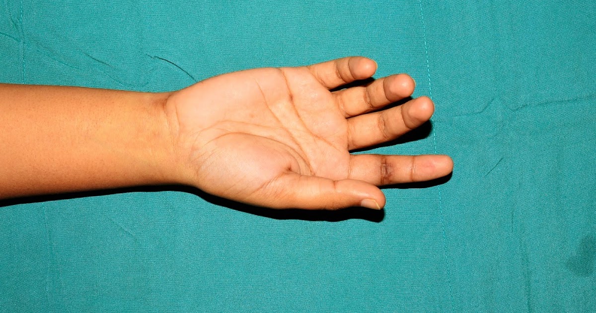 CRUSH INJURIES OF HAND AND UPPER LIMB INJURIES TWO MONTH OLD FLEXOR TENDON INJURY RIGHT INDEX