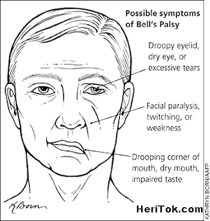 Bell's Palsy Penyakit Bells Palsy