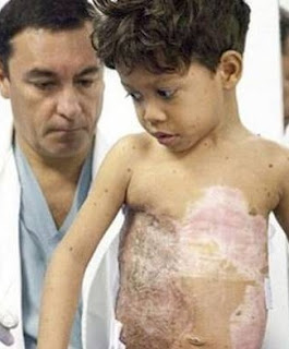 niño colombiano con enfermedad de caparazon