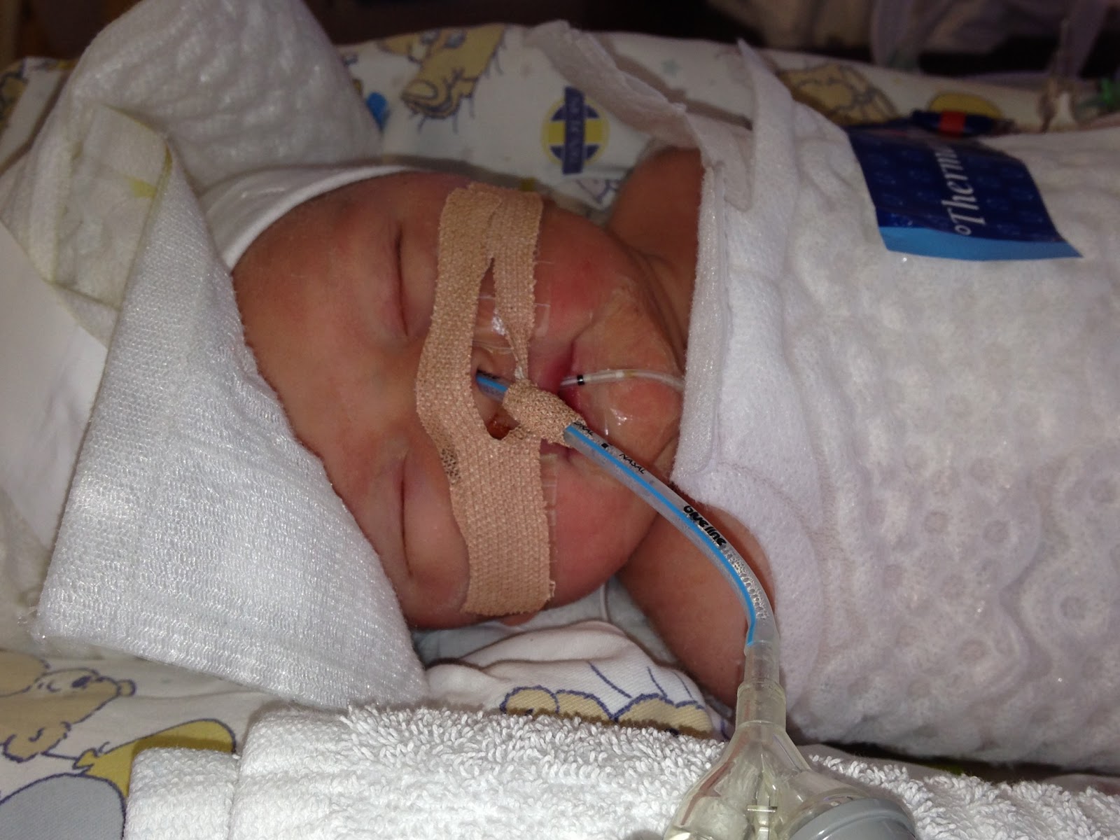 Our Birth Asphyxia Story The Shrink On Your Couch