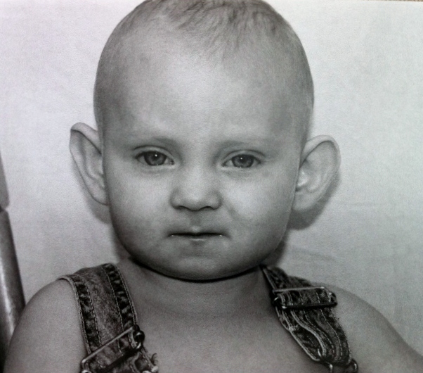 kabuki makeup syndrome