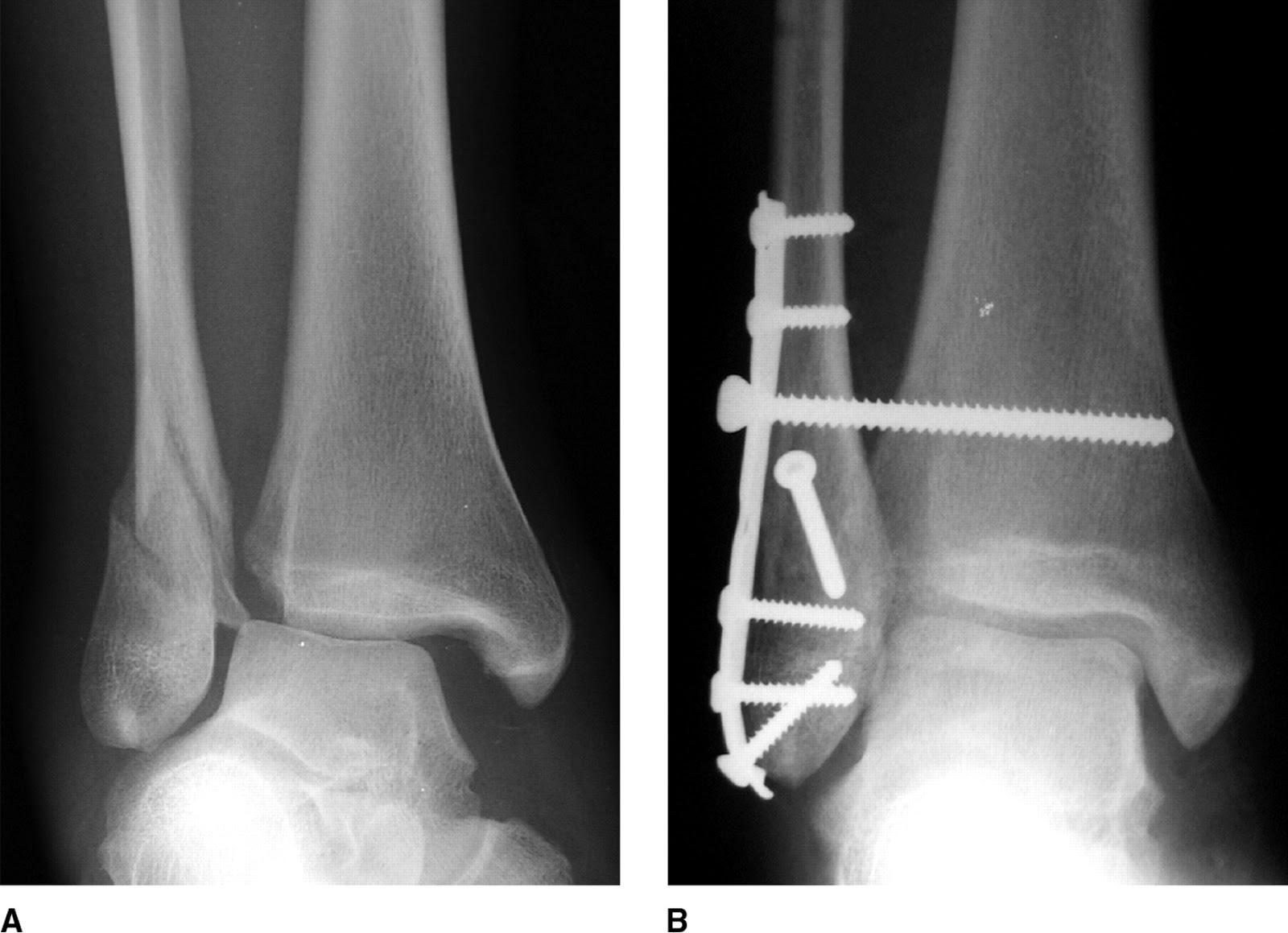 intermetatarsal neuroma