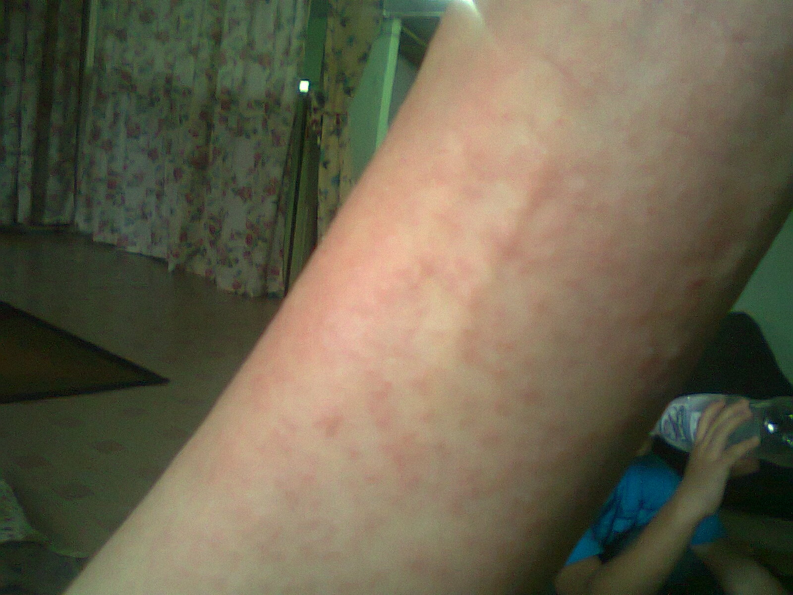 alialisakreatif by kolin zainal alergik ubat antibiotik