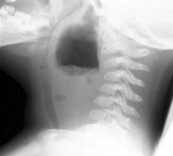Medicine Hack Retropharyngeal abscess Xray