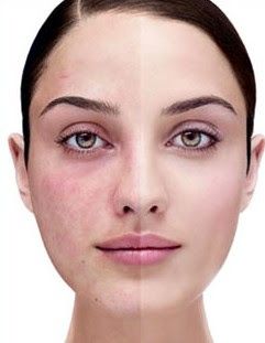 Post Acne Redness