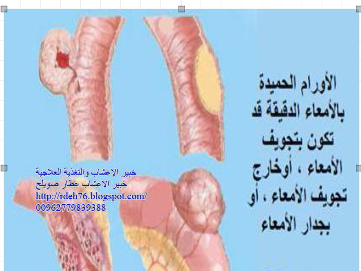 الاورام الحميدة السرطان الاورام خبير الاعشاب والتغذية العلاجية عطار صويلح