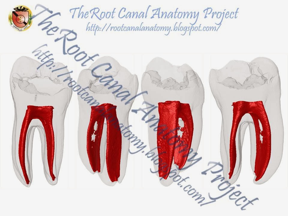 The Root Canal Anatomy Project Mandibular First Molar (with Isthmuses)